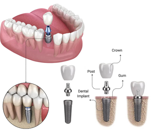 How Much Do Dental Implants Cost: Complete Price Breakdown and What Affects Your Bill